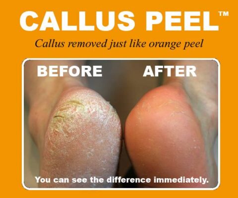 Callus Peel (inclus 10 traitements)